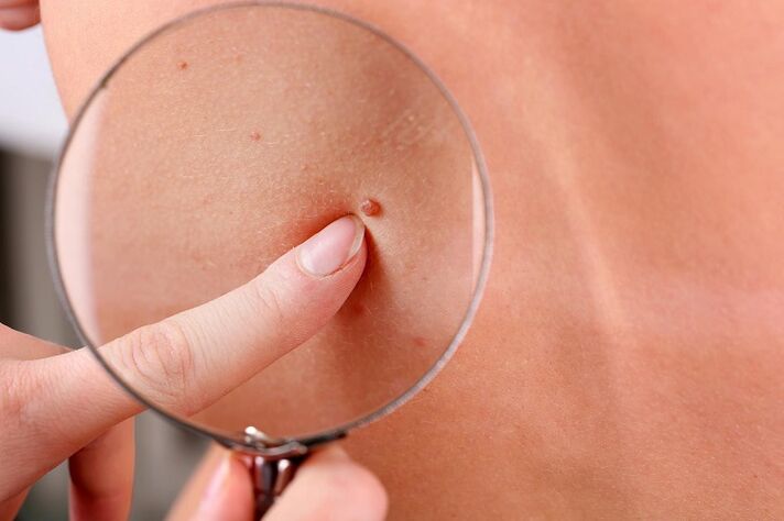 how to remove wart on face