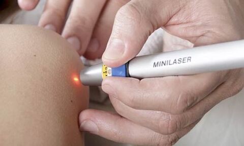 remove papilloma with laser