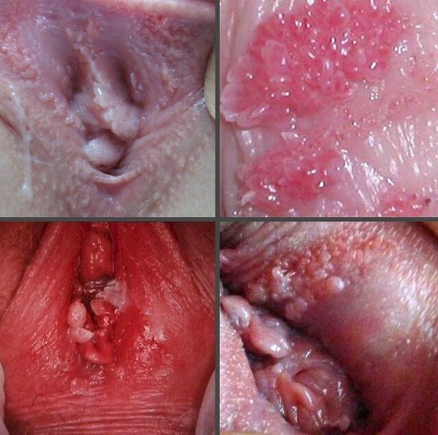 Vaginal papilloma close-up