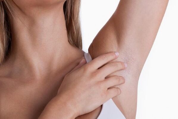 papillomas under the armpit of a woman