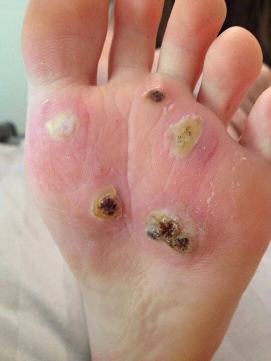 plants warts on the foot