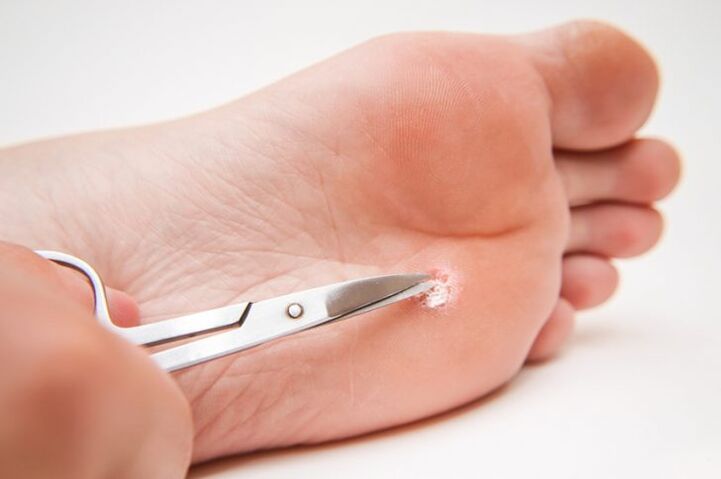 cut out the wart on the foot
