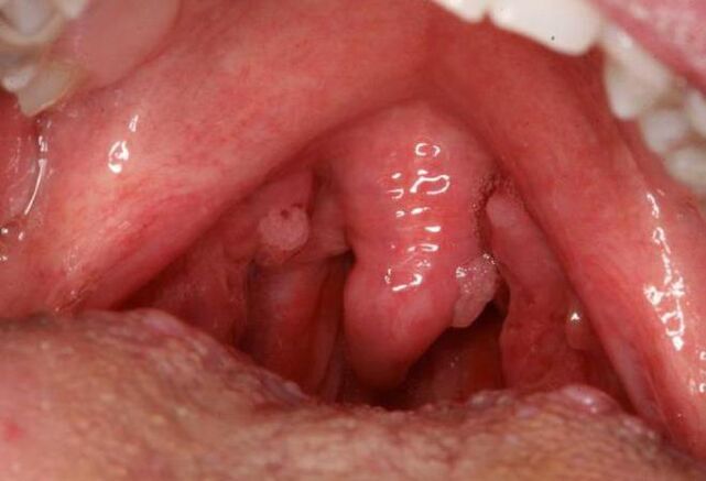 papillomas of the throat