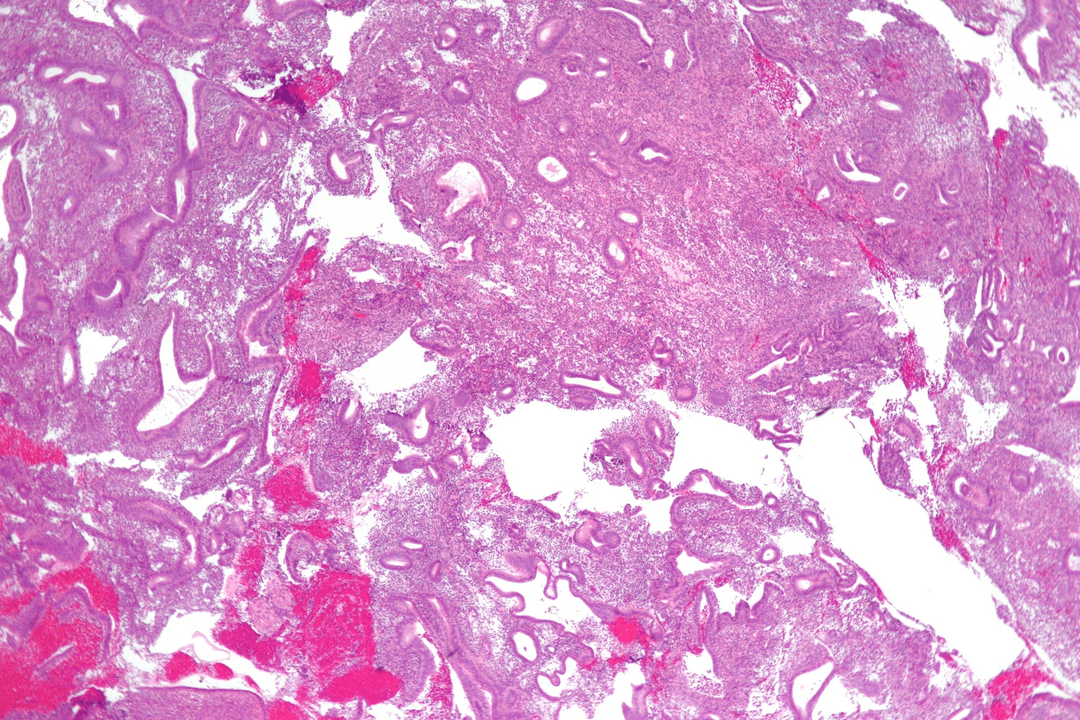squamous cell tumor