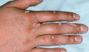types of warts and methods to remove them
